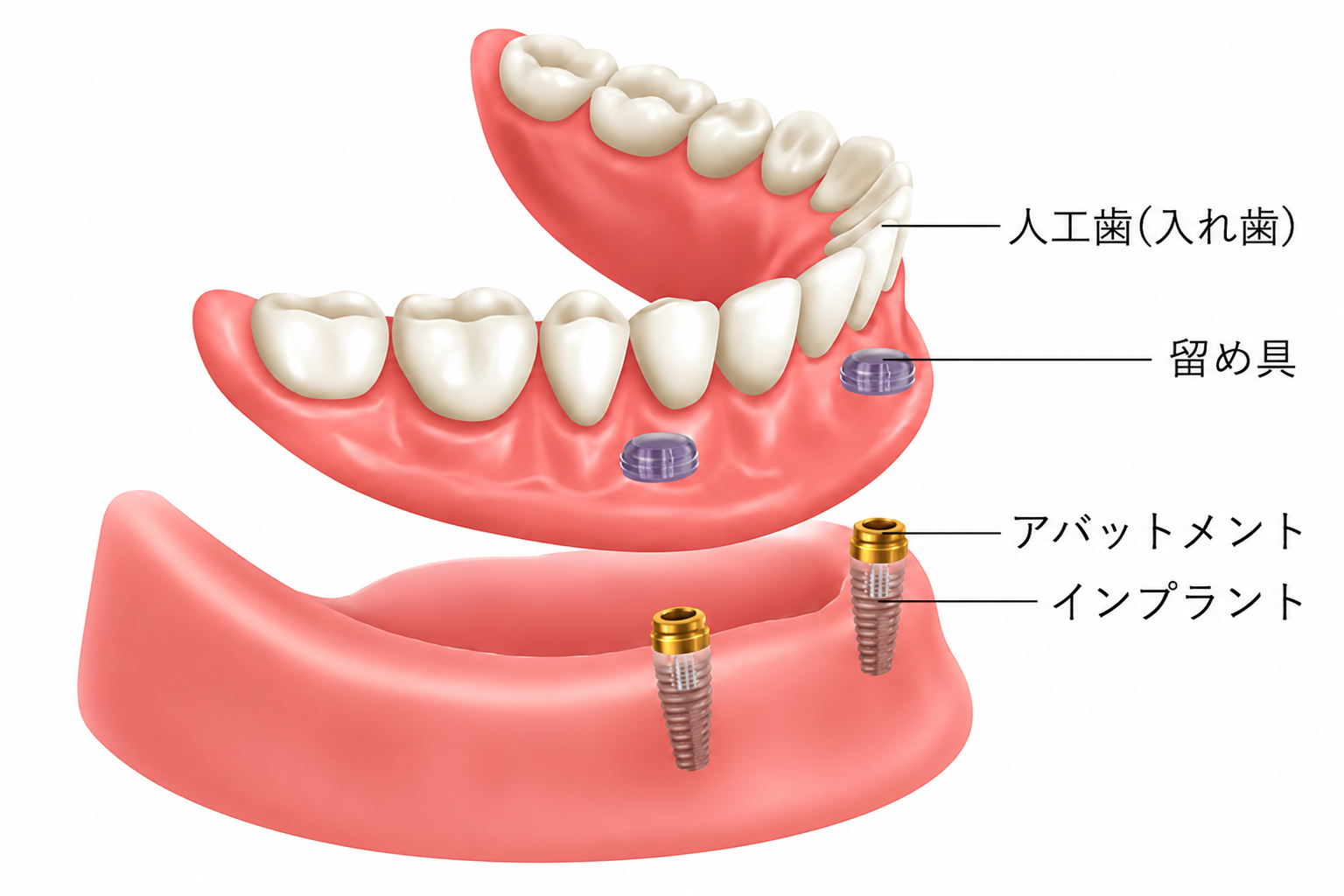オーバーデンチャーとは